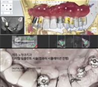 디지털 임플란트 수술[네비게이션임플란트]