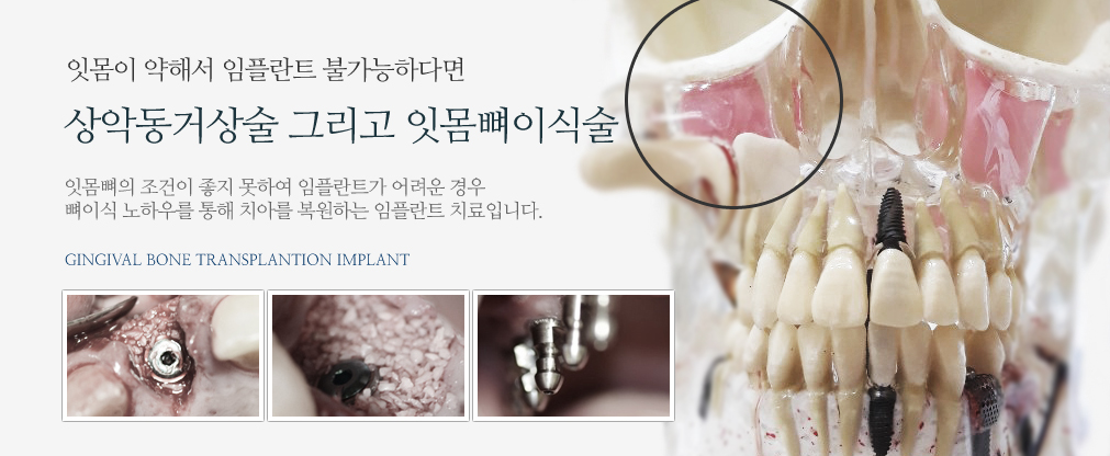 상악동거상술/치조골이식술